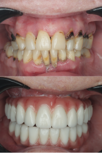 before-after
