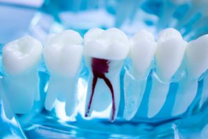 what is a root canal pulp