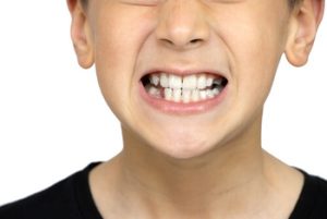 How Long Does Invisalign Take solution