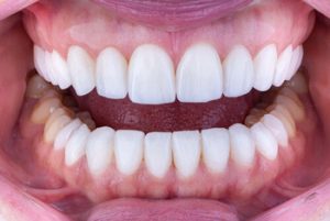 how long does teeth whitening last results