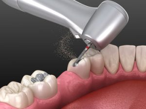 How-to-Whiten-Fillings-on-Front-Teeth-replacement