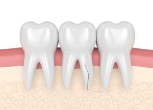 average number of root canals by age crack