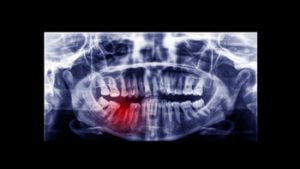 average number of root canals by age xray