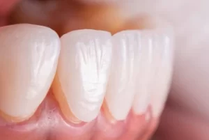 Can You Whiten Porcelain Veneers application