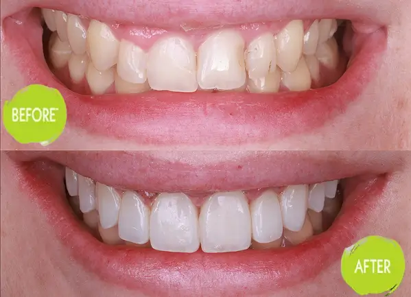 Veneers Casey Dentists Case 1
