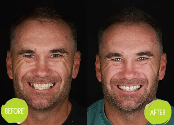 Veneers Casey Dentists Case 10