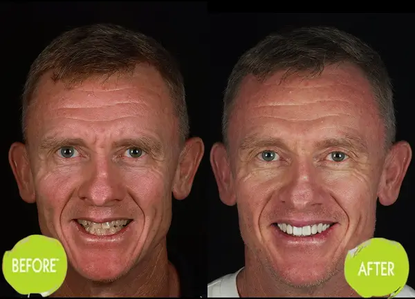 Veneers Casey Dentists Case 11