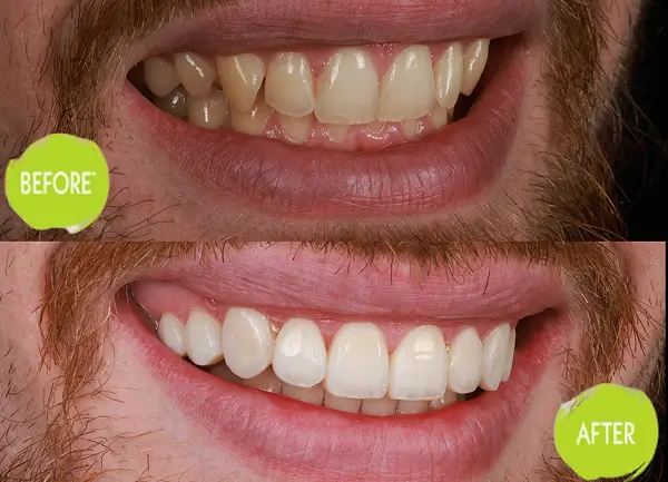 Veneers Casey Dentists Case 12