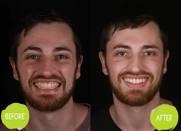 Veneers Casey Dentists Case 13