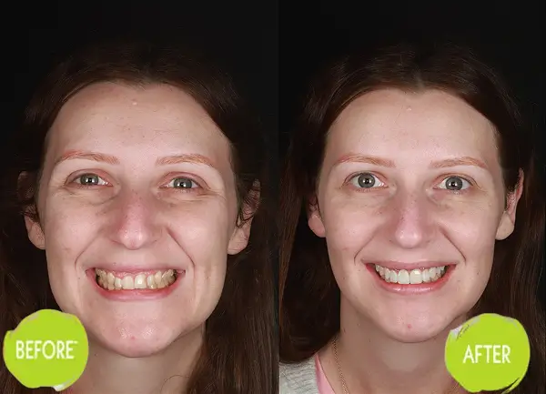 Veneers Casey Dentists Case 2