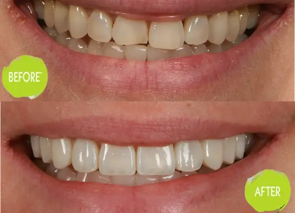 Veneers Casey Dentists Case 3