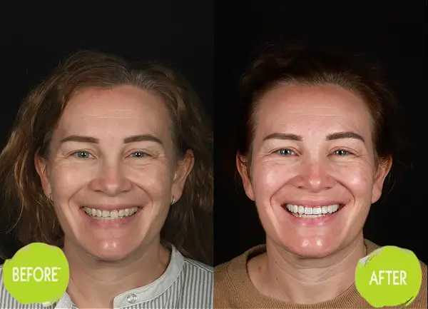 Veneers Casey Dentists Case 4