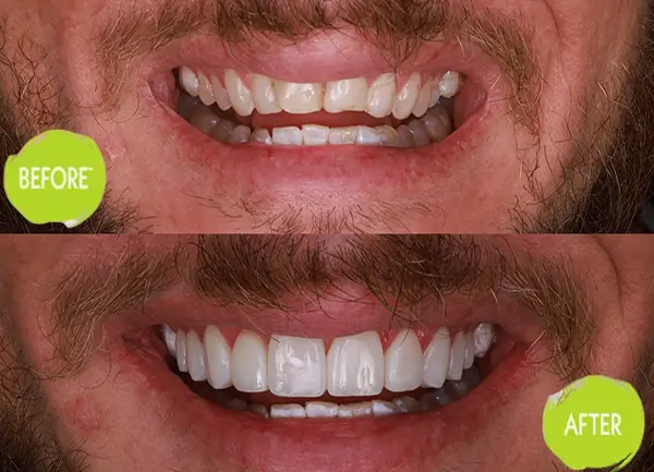Veneers Casey Dentists Case 5