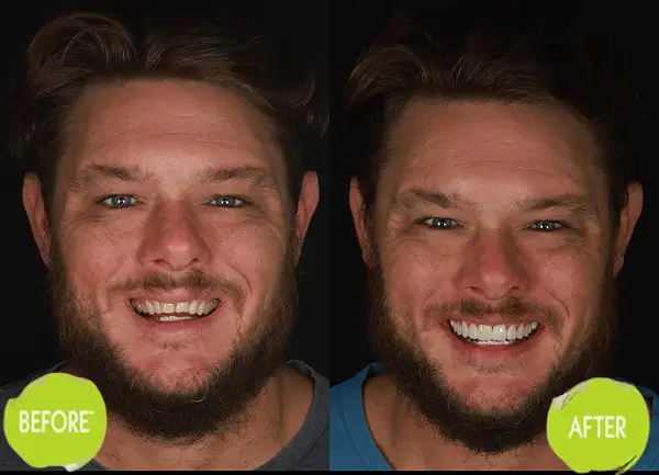 Veneers Casey Dentists Case 6