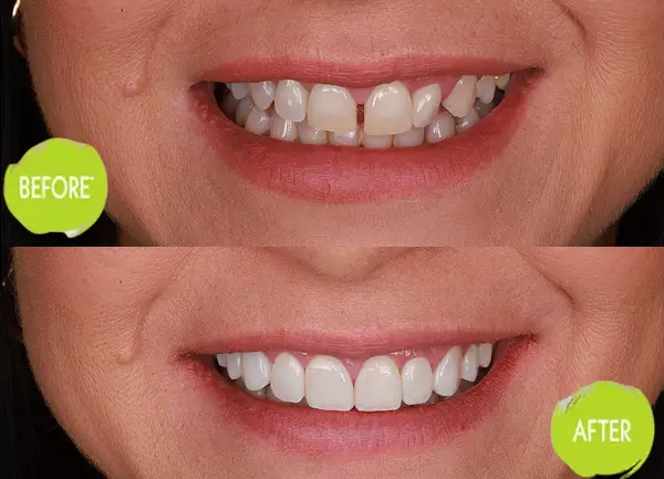 Veneers Casey Dentists Case 7