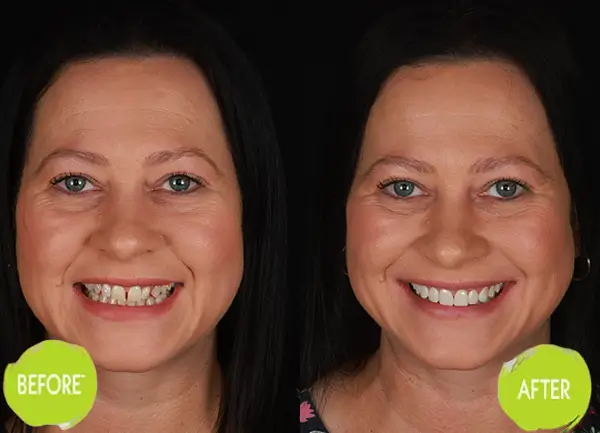 Veneers Casey Dentists Case 8