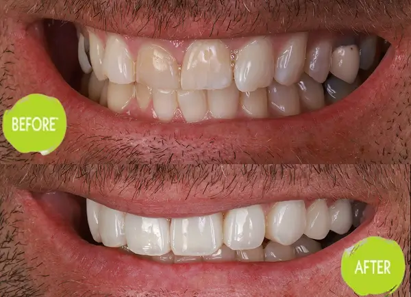 Veneers Casey Dentists Case 9