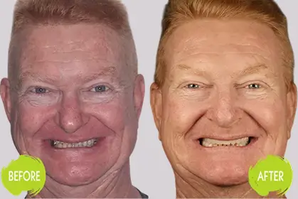 Dental Implants Casey Dentists 5