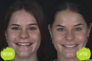 Dental Bonding Casey Dentists 1