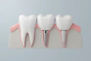 how to relieve pain from dental implant procedure