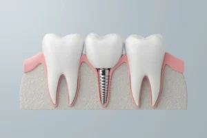 Dental Implant Healing Stages expectation