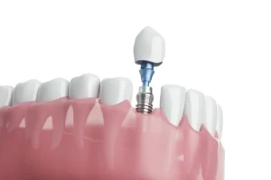 How to Speed Up Bone Graft Healing for implant