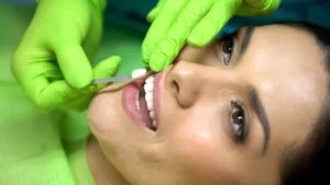Veneers for Overbite application